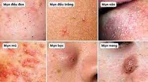 Điều trị mụn trứng cá sớm tránh sẹo rỗ ảnh 1