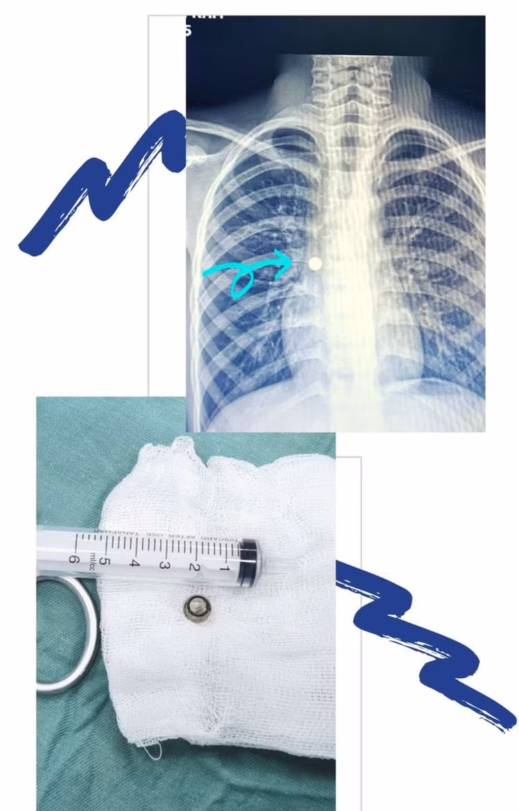Viên pin trong phế quản của trẻ Viên pin trong phế quản của trẻ