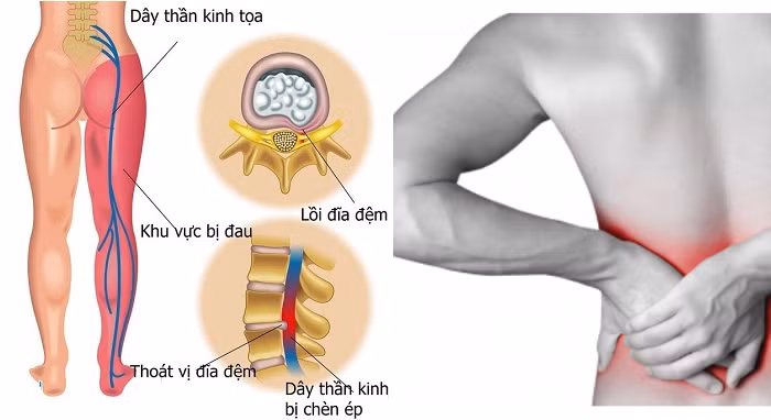 Thoát vị đĩa đệm liên quan đến sự nứt của vòng xơ - Ảnh minh họa Thoát vị đĩa đệm liên quan đến sự nứt của vòng xơ - Ảnh minh họa