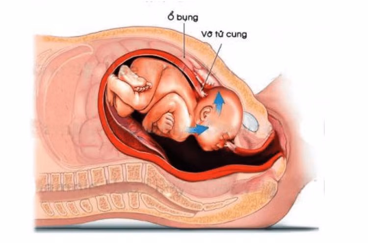 Biểu hiện của vỡ tử cung - Ảnh minh họa