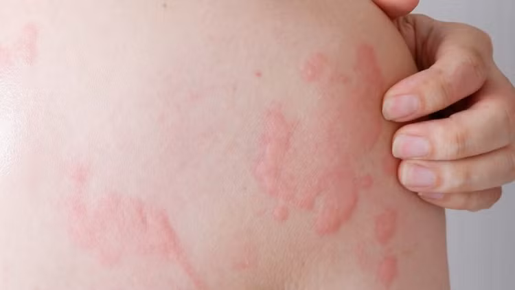 Mày đay có thể gây tử vong nếu không xử trí kịp thời Mày đay có thể gây tử vong nếu không xử trí kịp thời