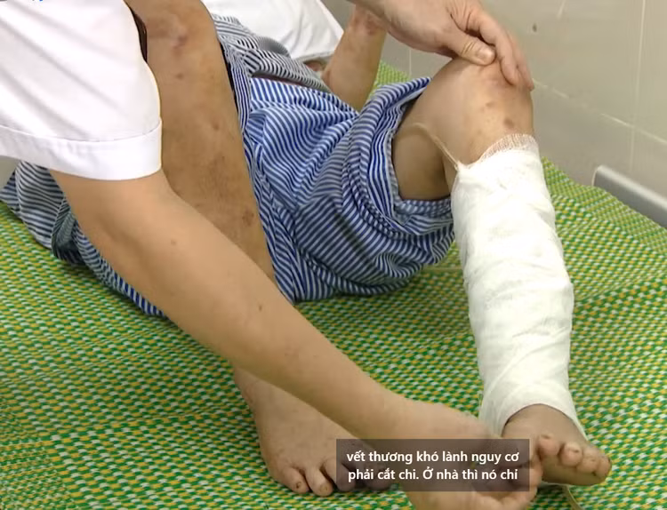 Nguy cơ phải cắt cụt chi vì vết thương khó lành - Ảnh BVCC Nguy cơ phải cắt cụt chi vì vết thương khó lành - Ảnh BVCC