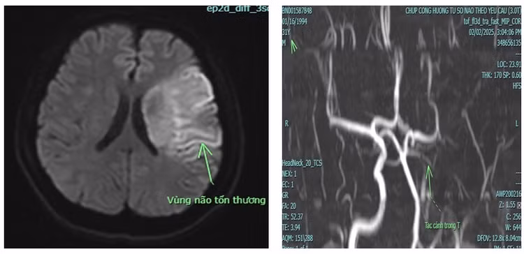 Hình ảnh tổn thương nhồi máu não cấp do tắc động mạch cảnh trong trái - Ảnh BVCC