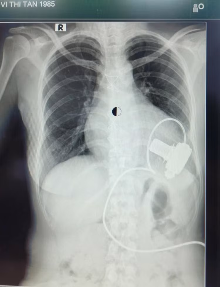 Cấy ghép tim nhân tạo hỗ trợ tâm thất LVAD ở bệnh nhân