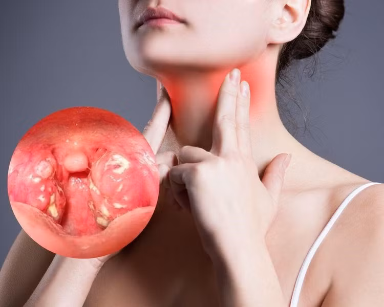 Bác sĩ chỉ rõ biến chứng và thời điểm cắt viêm amidan hợp lý?