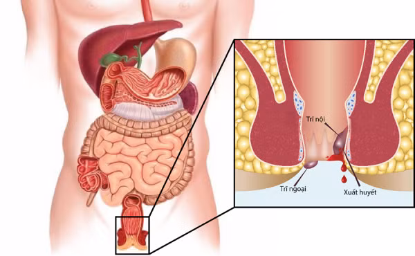 Bệnh trĩ - Ảnh minh họa Bệnh trĩ - Ảnh minh họa