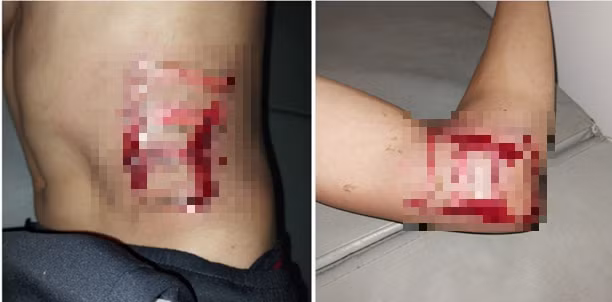 Vết thương bệnh nhân do bị sét đánh lúc mới nhập viện - Ảnh: Trung tâm Y tế huyện Bắc Sơn