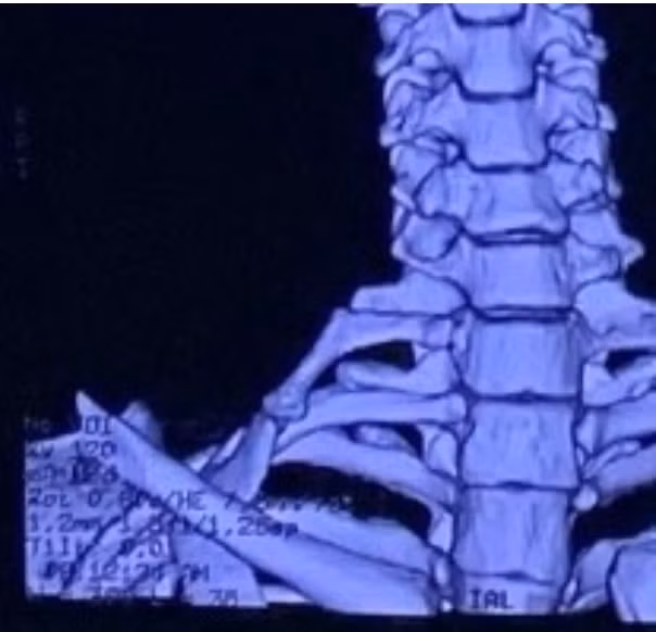 Hy hữu: Cô gái 22 tuổi có xương sườn mọc ở cổ ảnh 2