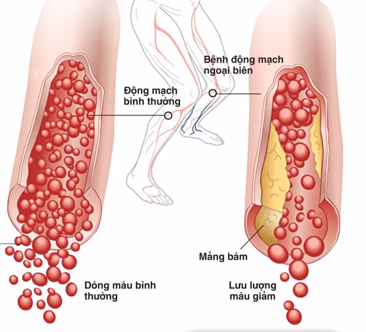 Xơ vữa, hẹp mạch gây thiếu máu mạn tính chi - Ảnh minh họa