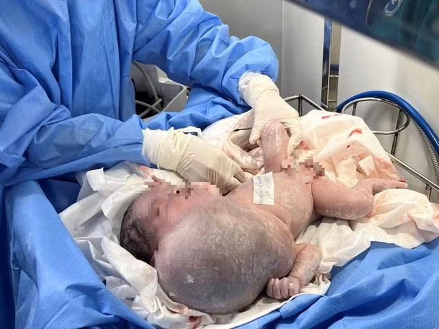 Bé trai có khối bướu dị dạng bạch huyết lớn nhất trong y văn thế giới (Ảnh: BVCC)