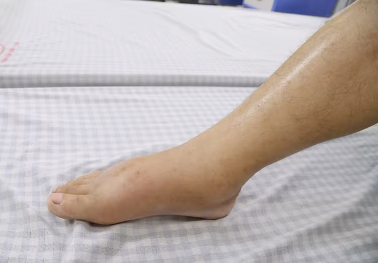 Hình ảnh bàn chân của người bệnh bị phù nề - Ảnh: BVCC Hình ảnh bàn chân của người bệnh bị phù nề - Ảnh: BVCC