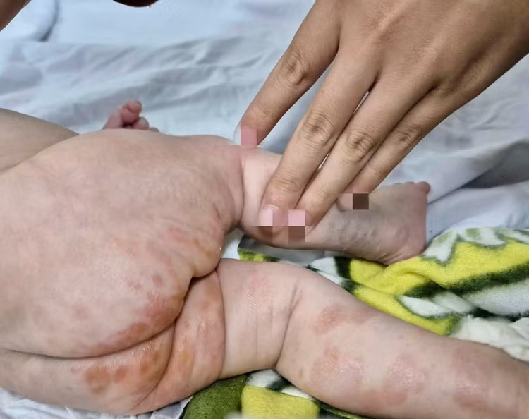 Bé trai 2 tháng tuổi loét khắp người vì mắc giang mai bẩm sinh ảnh 1 Bé trai 2 tháng tuổi loét khắp người vì mắc giang mai bẩm sinh ảnh 1