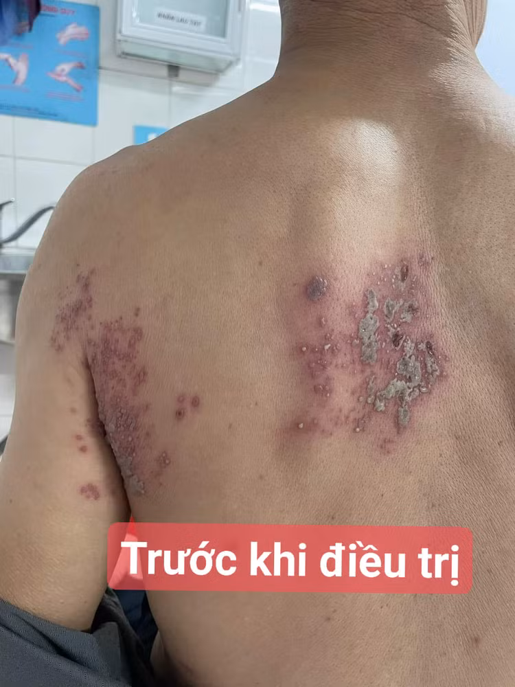 Biểu hiện của zona thần kinh Biểu hiện của zona thần kinh