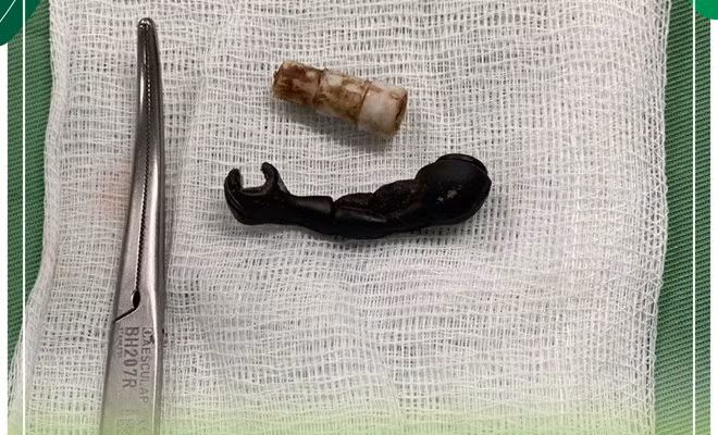 Hai dị vật được lấy ra từ vùng kín của bé gái