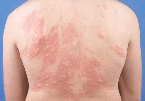 Chuyên gia mách cách xử lý đúng khi bị mề đay ảnh 1 Chuyên gia mách cách xử lý đúng khi bị mề đay ảnh 1