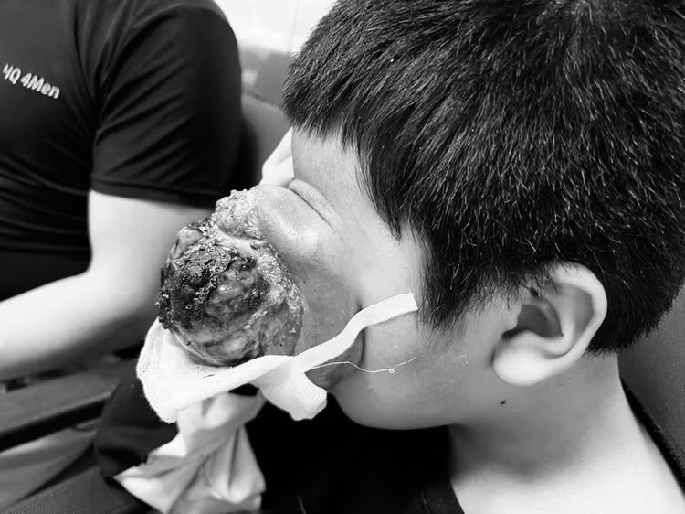 U quái đẩy lồi mắt cậu bé 4 tuổi U quái đẩy lồi mắt cậu bé 4 tuổi