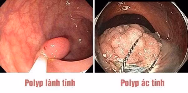 Polyp đại trực tràng - Ảnh minh họa Polyp đại trực tràng - Ảnh minh họa