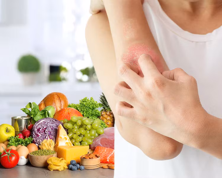 Những lưu ý dinh dưỡng giúp bệnh nhân vảy nến kiểm soát bệnh - Ảnh BVCC