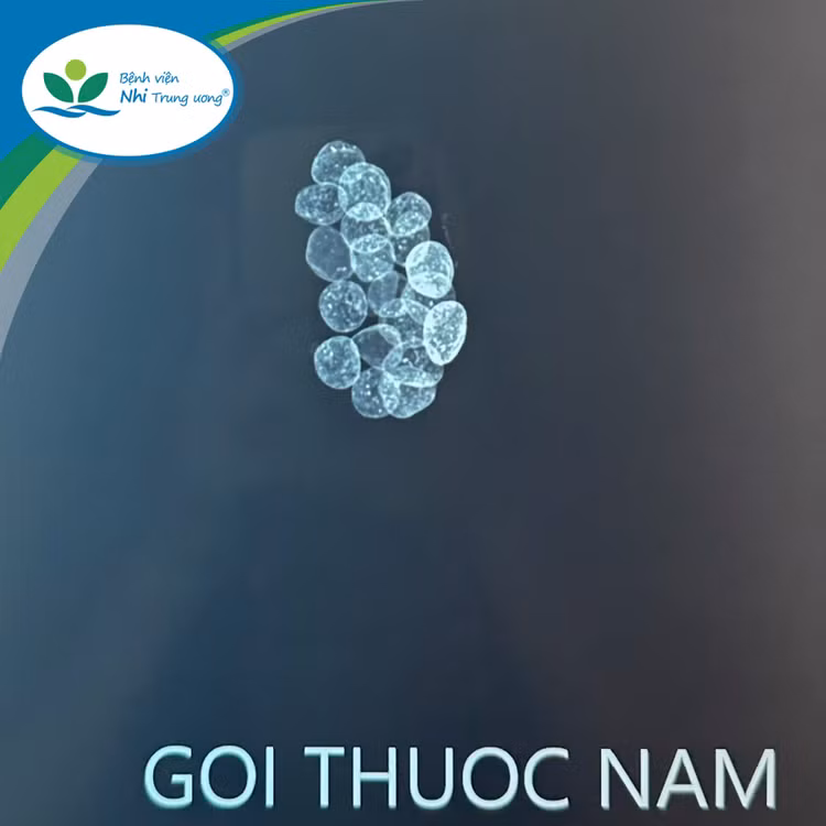 Hình ảnh viên thuốc nam trẻ uống không rõ nguồn gốc có chứa chì trên phim chụp Xquang