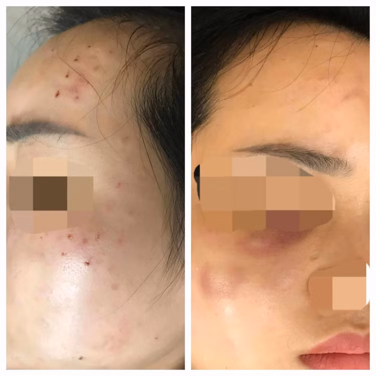 Nữ bệnh nhân bị tiêm nhầm sữa rửa mặt vào da - Ảnh BVCC