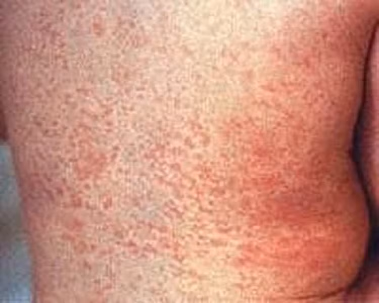 Ban xuất hiện khoảng 5-6 ngày và khi “tàn” sẽ có màu hơi nâu nâu rồi sẽ biến mất, để lại lớp da khô, bong tróc. Ban xuất hiện khoảng 5-6 ngày và khi “tàn” sẽ có màu hơi nâu nâu rồi sẽ biến mất, để lại lớp da khô, bong tróc.