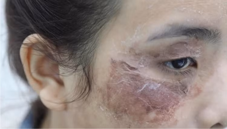 Một trường hợp hỏng da khác do peel da tại nhà - Ảnh BVCC