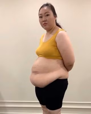 Chị Q. trước khi phẫu thuật Chị Q. trước khi phẫu thuật