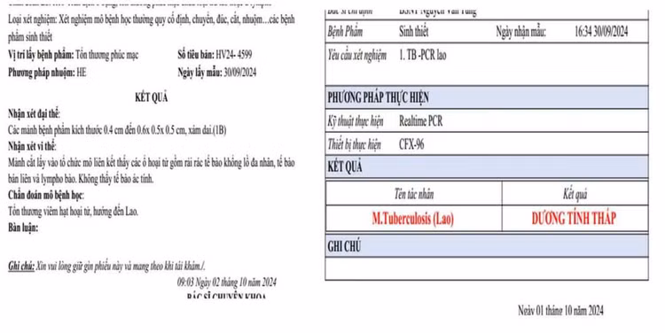 Phiếu xét nghiệm bệnh nhân dương tính với lao màng bụng - Ảnh BVCC Phiếu xét nghiệm bệnh nhân dương tính với lao màng bụng - Ảnh BVCC