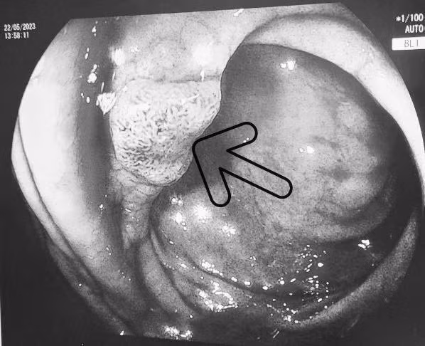 Sụt cân, ăn kém đi khám phát hiện 2 loại ung thư ảnh 2 Sụt cân, ăn kém đi khám phát hiện 2 loại ung thư ảnh 2
