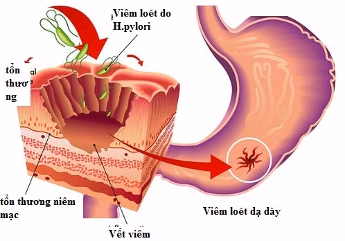 Bác sĩ chỉ rõ tác nhân gây viêm loét dạ dày, hành tá tràng ảnh 1