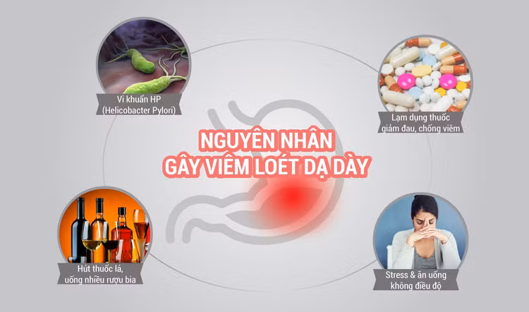 Stress, ăn uống không điều độ dễ viêm loét dạ dày, tá tràng Stress, ăn uống không điều độ dễ viêm loét dạ dày, tá tràng