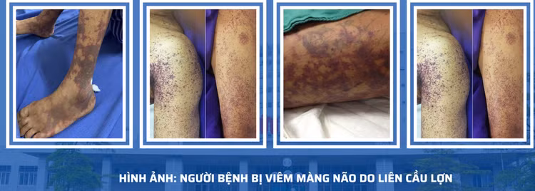 Ăn nem chua, quý ông 42 tuổi bị viêm màng não do liên cầu lợn - Ảnh BVCC Ăn nem chua, quý ông 42 tuổi bị viêm màng não do liên cầu lợn - Ảnh BVCC