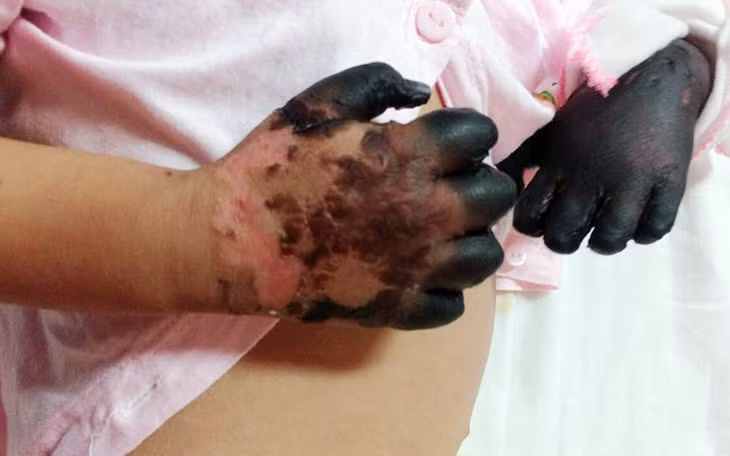 Bác sĩ chỉ rõ lý do bệnh than nguy hiểm: cần biết cách phòng tránh Bác sĩ chỉ rõ lý do bệnh than nguy hiểm: cần biết cách phòng tránh