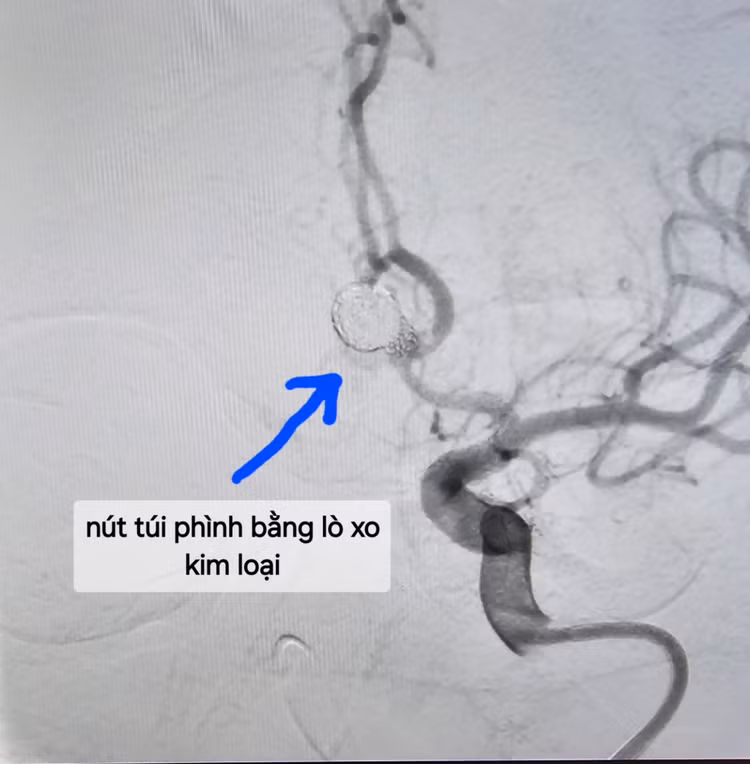 Nút túi phình bằng lò xo kim loại - Ảnh BVCC
