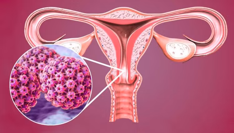 HPV dễ gây ung thư cổ tử cung - Ảnh minh họa