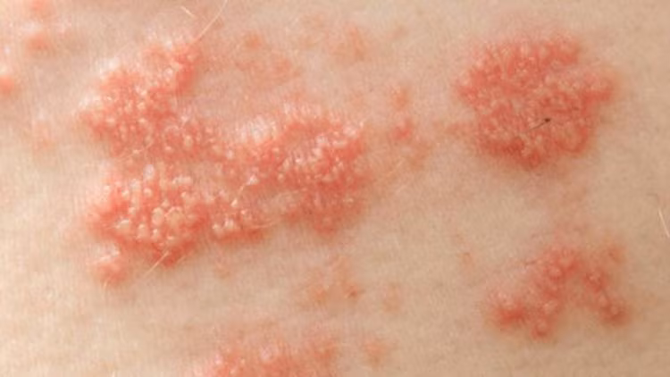 HPV gây u nhú ở người - Ảnh BVCC