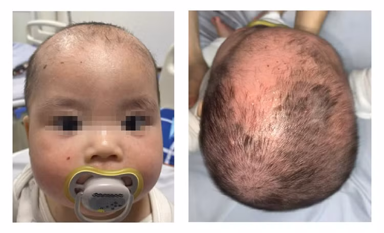 Hình ảnh của trẻ sau 4 ngày điều trị Bệnh viện Da liễu Trung ương