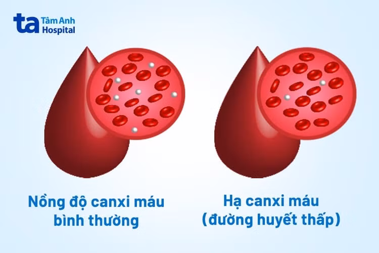 Biểu hiện hạ canxi khi xét nghiệm máu.