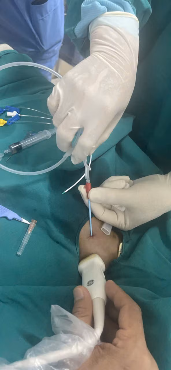 Các bác sĩ can thiệp để cứu bệnh nhân - Ảnh BVCC Các bác sĩ can thiệp để cứu bệnh nhân - Ảnh BVCC