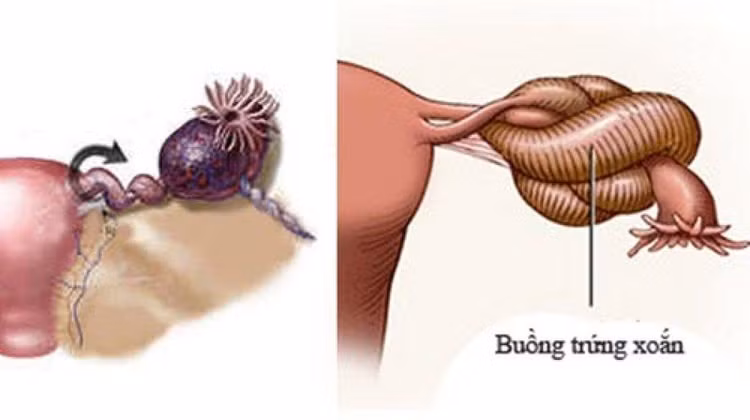U buồng trứng xoắn.