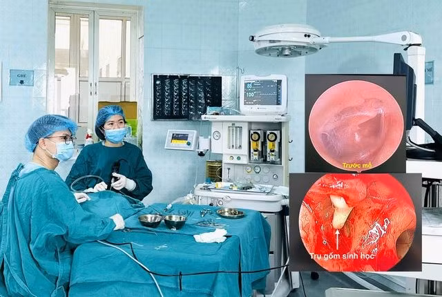 Lần đầu tạo hình xương con phục hồi sức nghe cho bệnh nhi bị cholesteatoma tại Bệnh viện Sản nhi Thanh Hóa - Ảnh BVCC